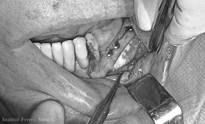 institut ferres amat cirurgia oral maxilofacial